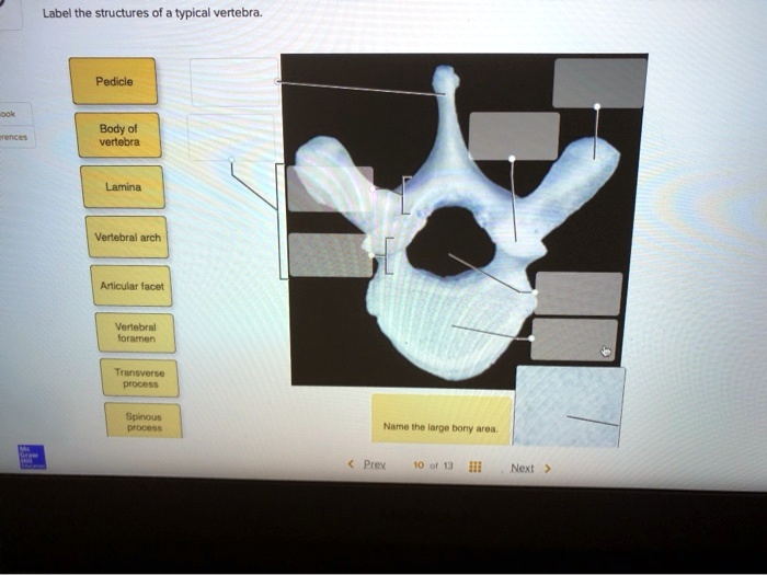 Label the structures of the typical vertebra